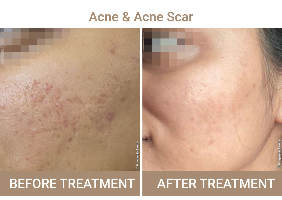 Acne And Acne-Scar Treatment | Iksana Wellness