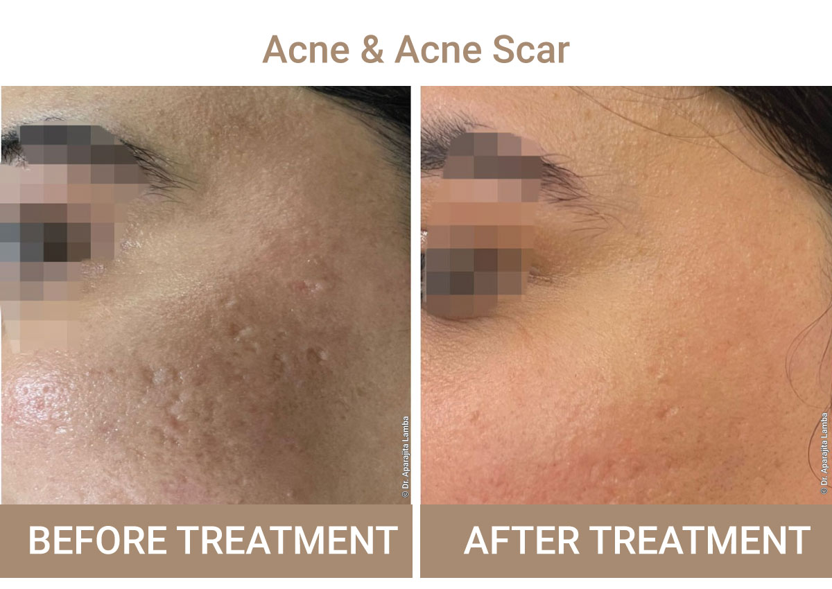 Acne And Acne-Scar Treatment | Iksana Wellness