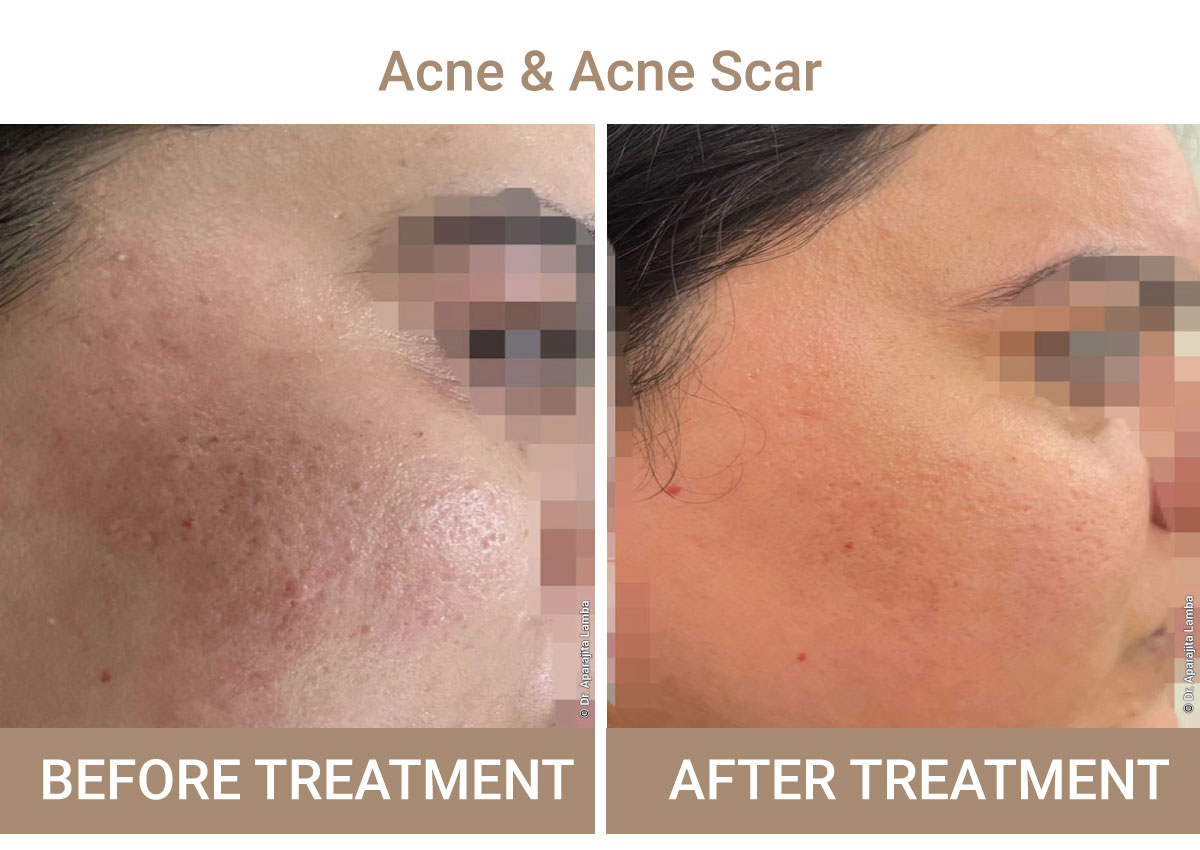 Acne And Acne-Scar Treatment | Iksana Wellness