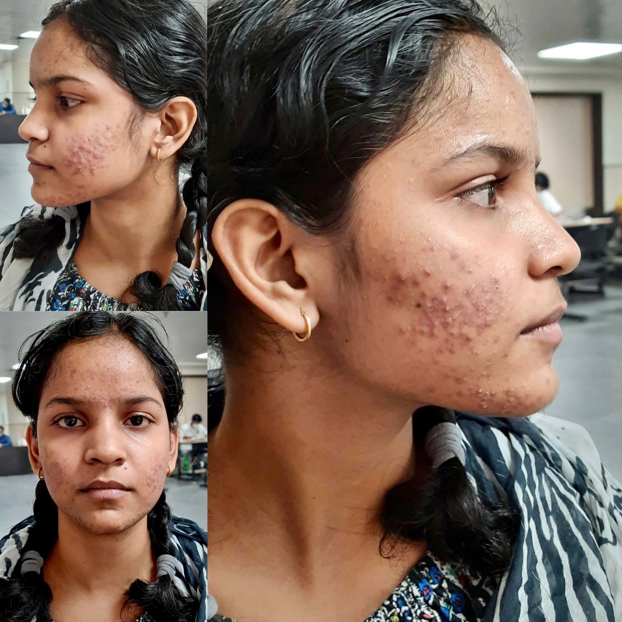 Acne Scars | Iksana Wellness