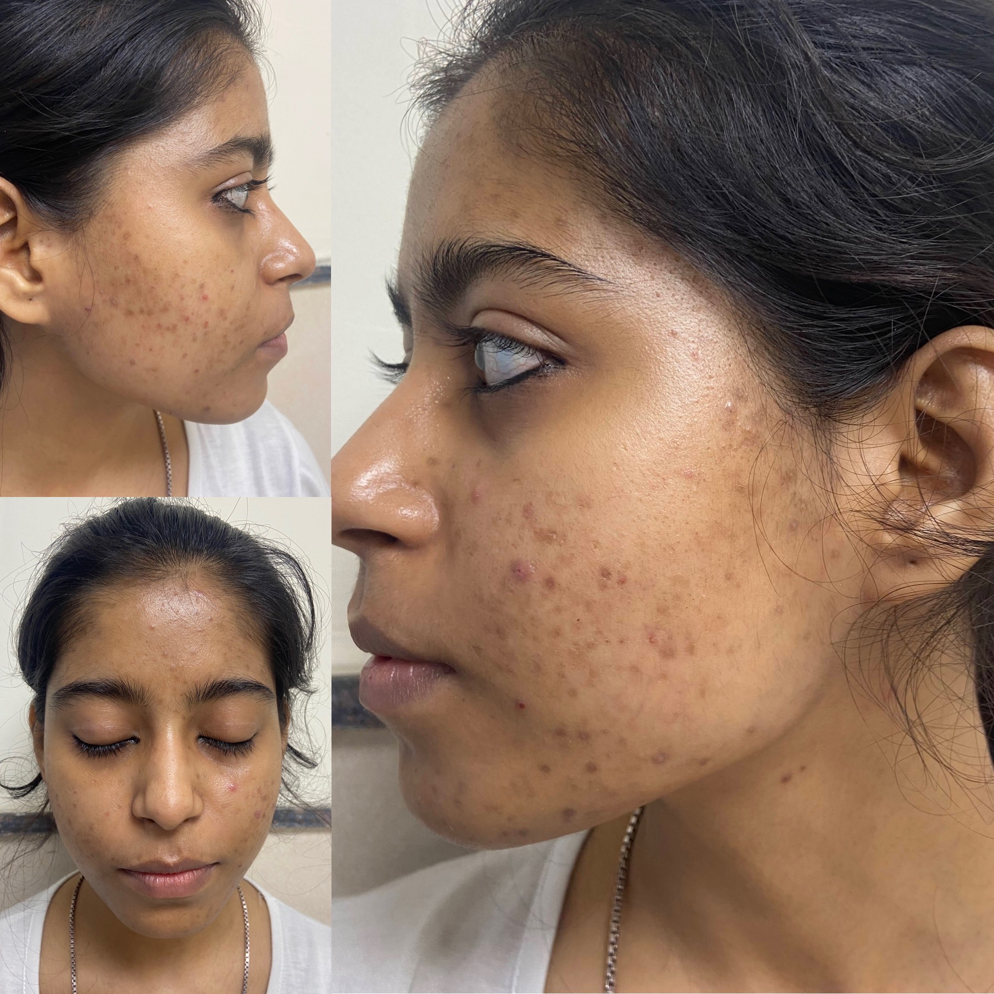 Acne | Iksana Wellness