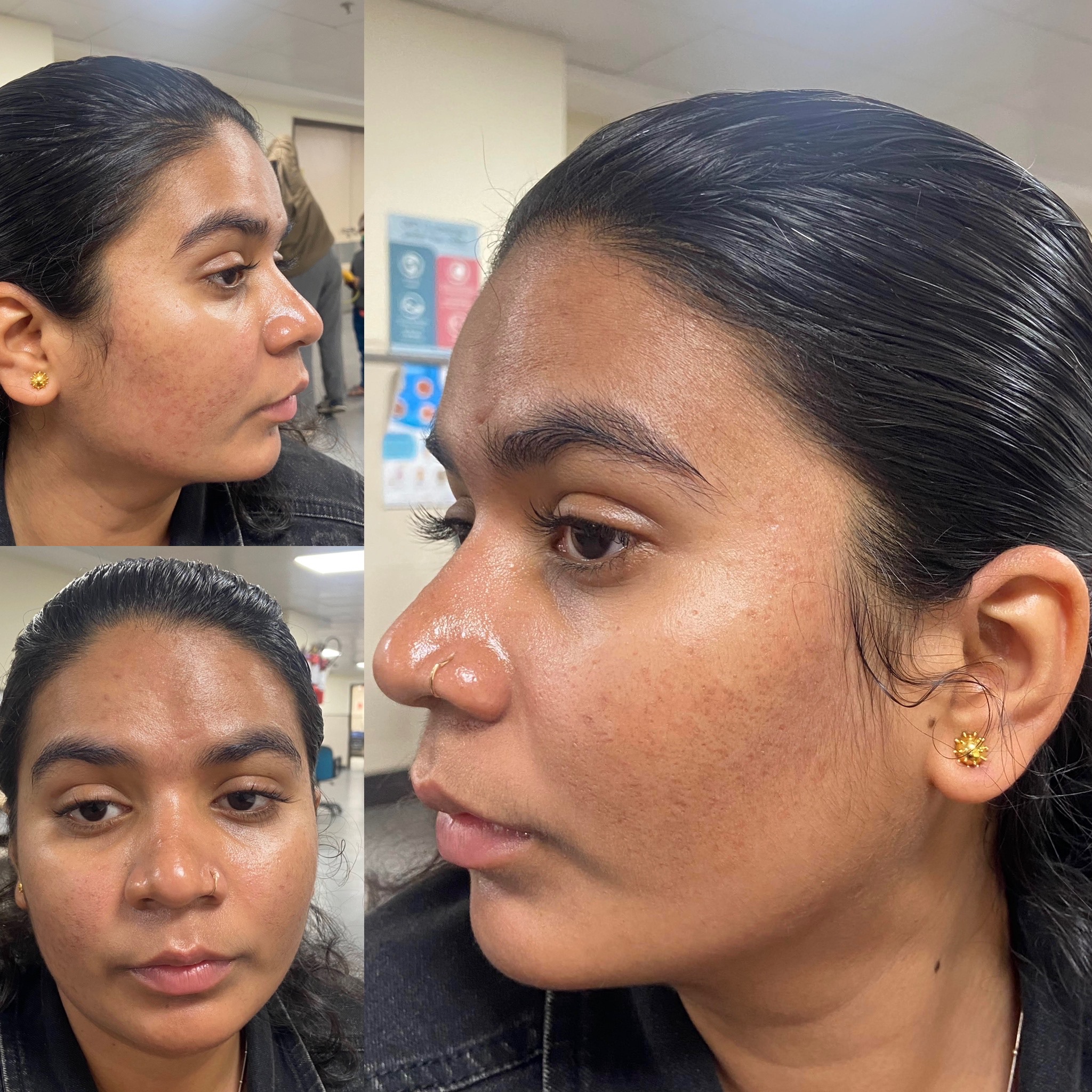 Pigmentation | Iksana Wellness