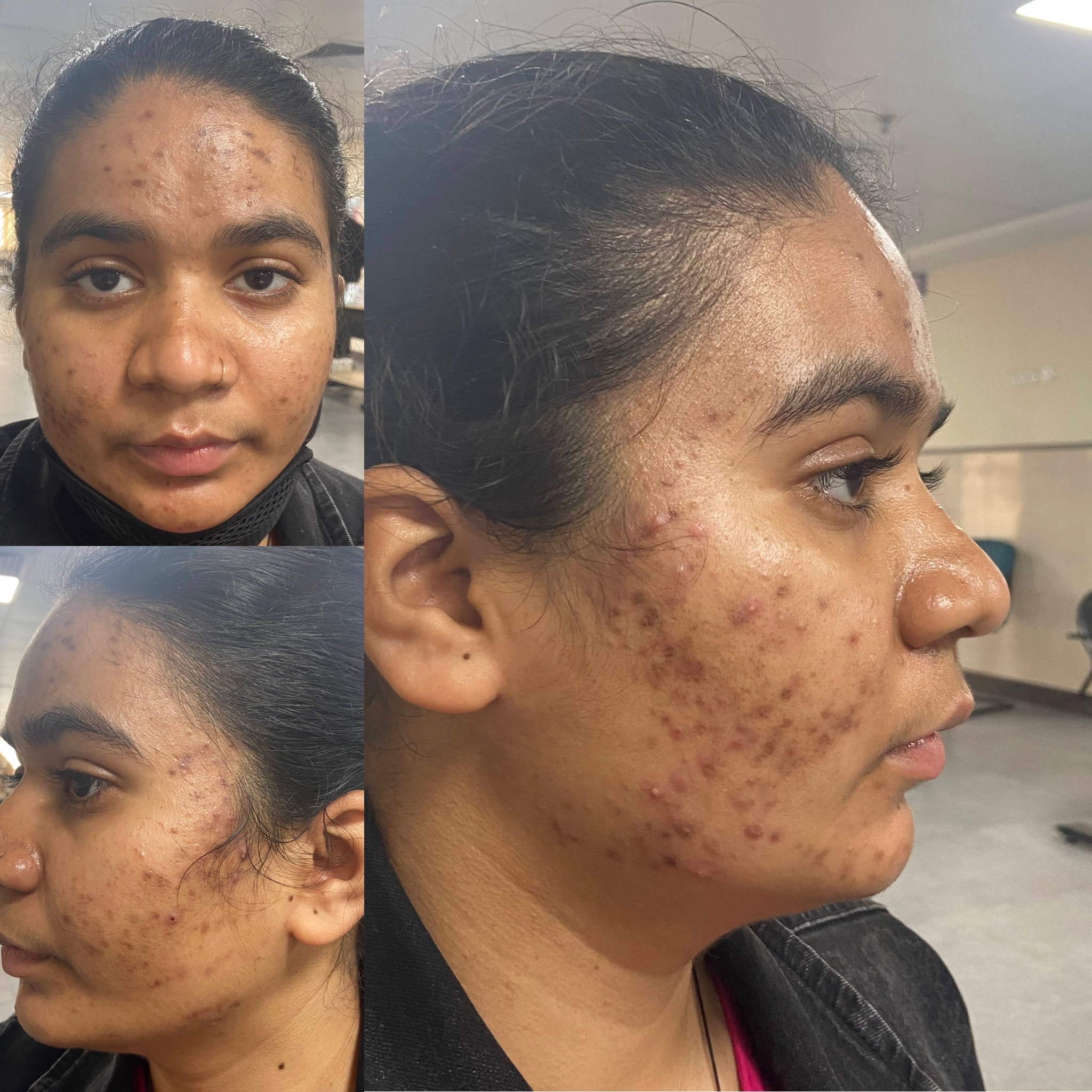 Pigmentations | Iksana Wellness