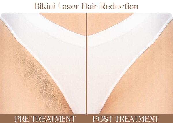 Bikini Laser Hair Reduction | Iksana Wellness