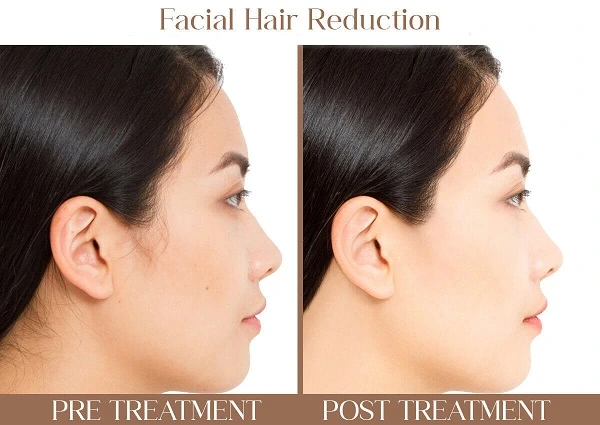 Facial Hair Reduction | Iksana Wellness