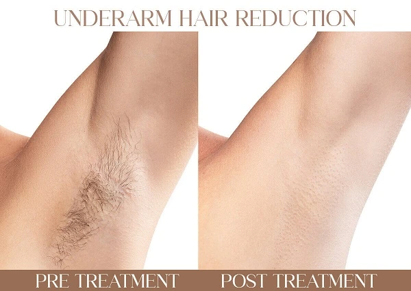 Underarm Hair Reduction | Iksana Wellness