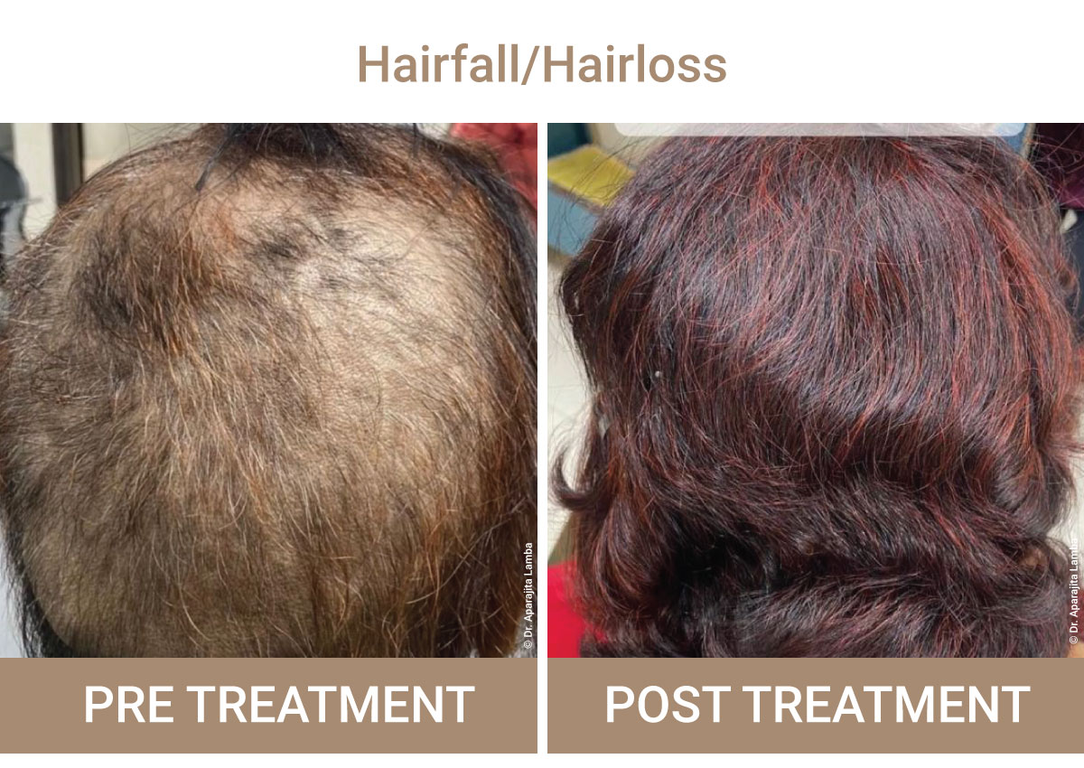Dandruff Treatment | Iksana Wellness
