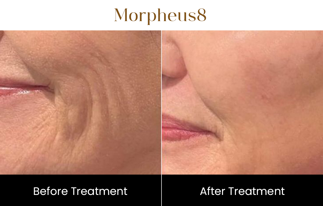 Morpheus8 Rf Microneedling | Iksana Wellness