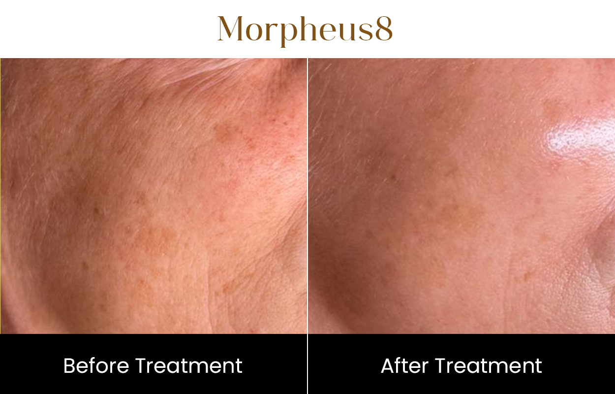Morpheus8 Rf Microneedling | Iksana Wellness