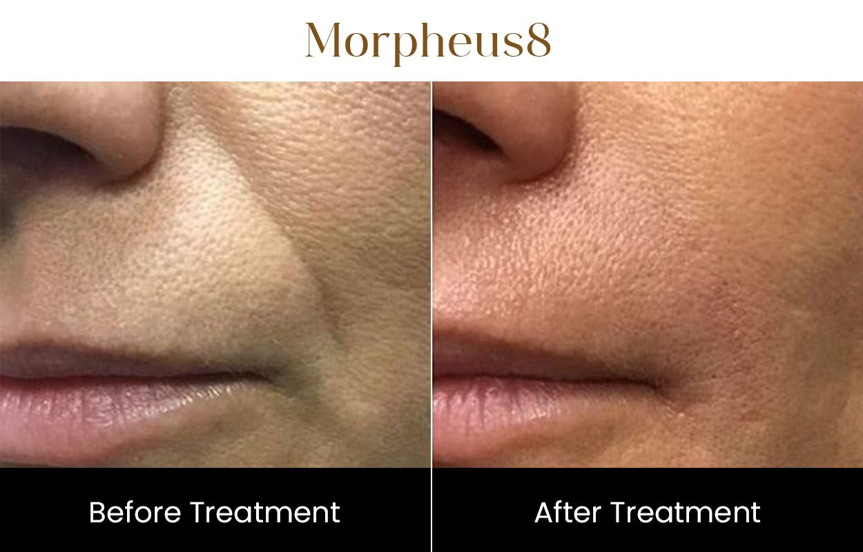 Morpheus8 Rf Microneedling | Iksana Wellness