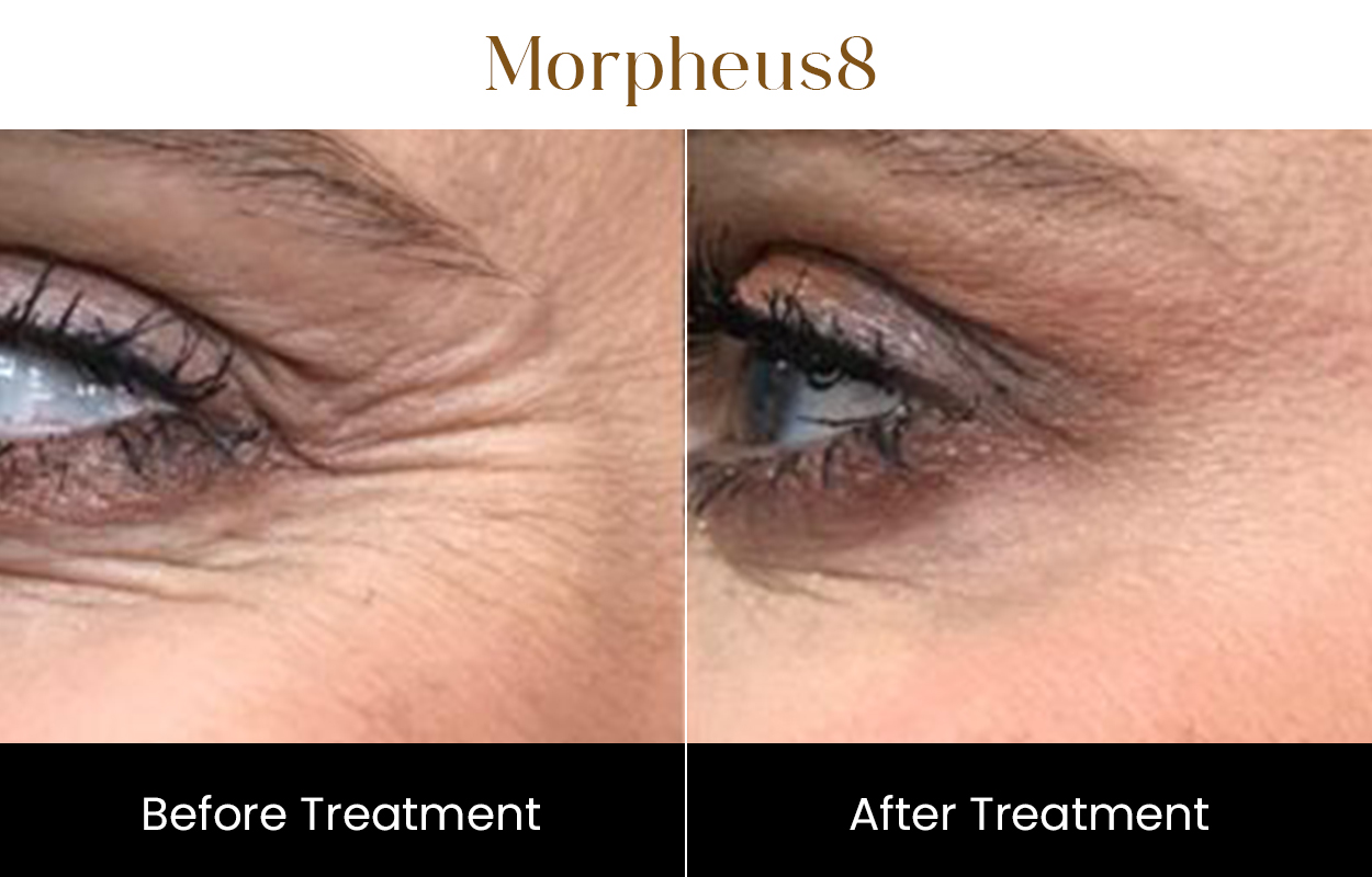 Morpheus8 Rf Microneedling | Iksana Wellness