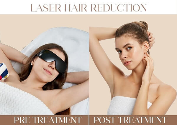 Laser Hair Reduction | Iksana Wellness