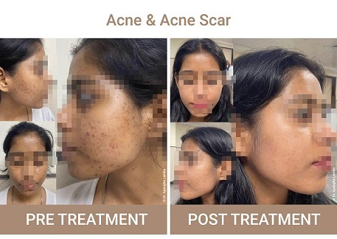 acne and acne scar treatment