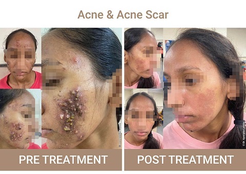 acne and acne scar treatment