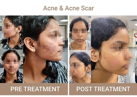 acne and acne scar treatment