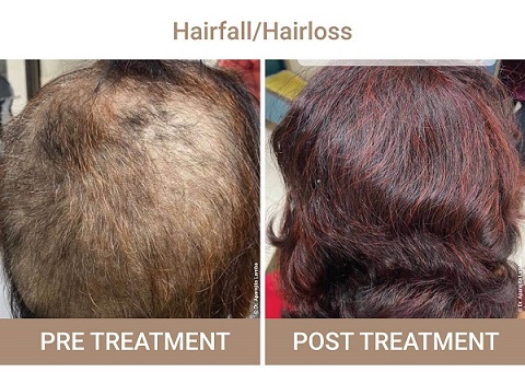 hair Loss Treatment