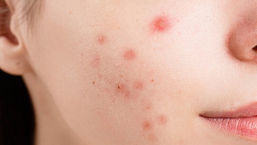 Acne and Acne Scar