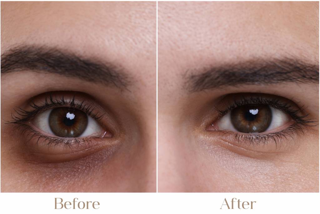 Dark Circle Treatment in Delhi