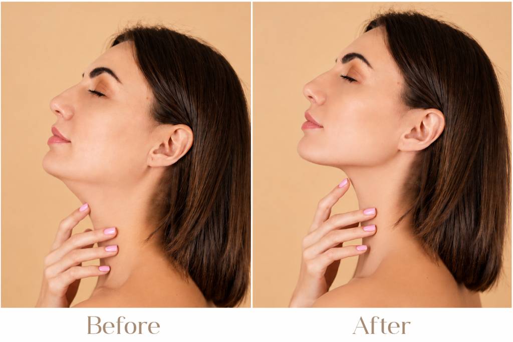 Double-Chin-Reduction-Treatment.