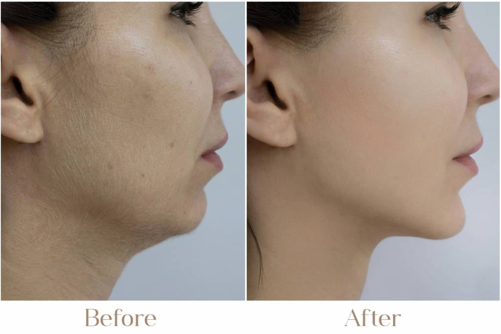 Laser Facial Hair Removal in Delhi