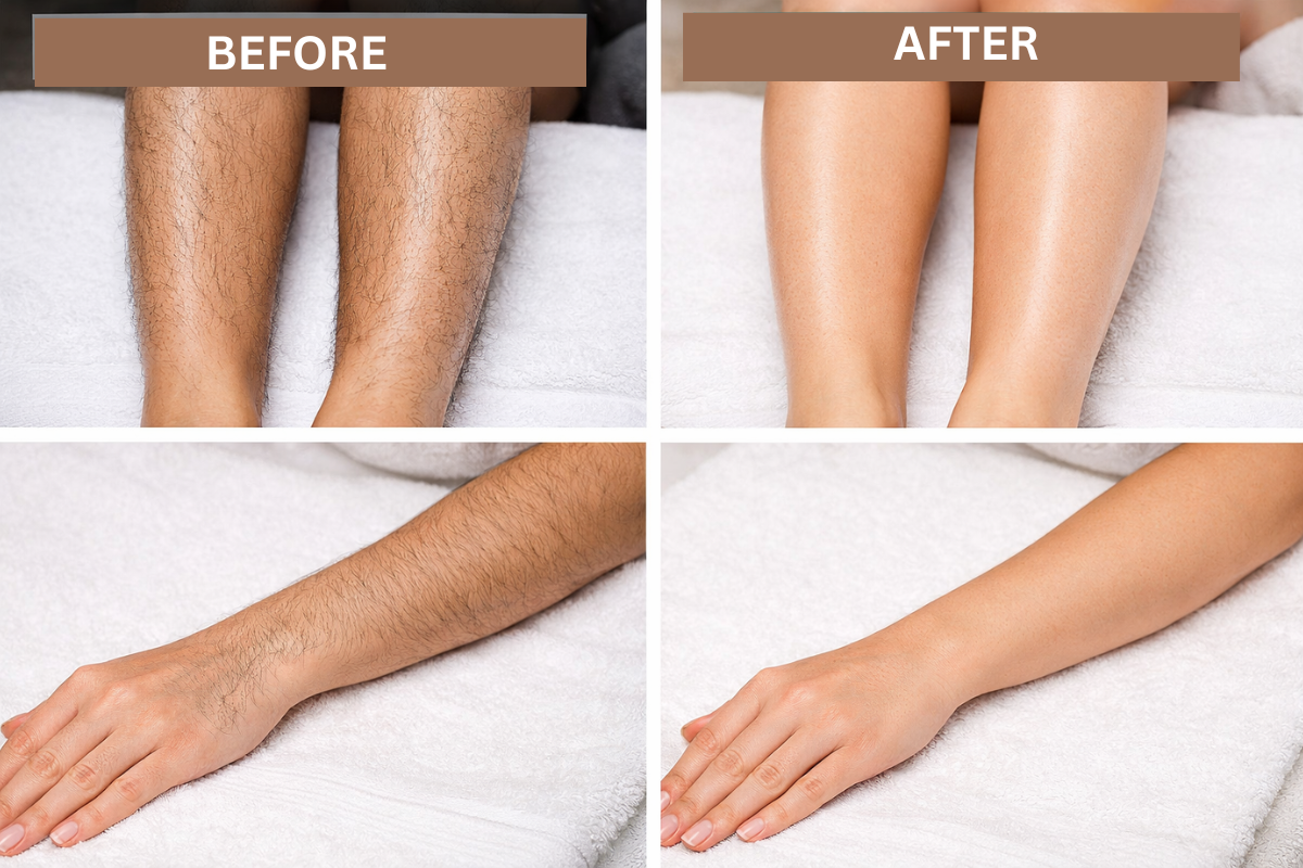Laser Hair Removal