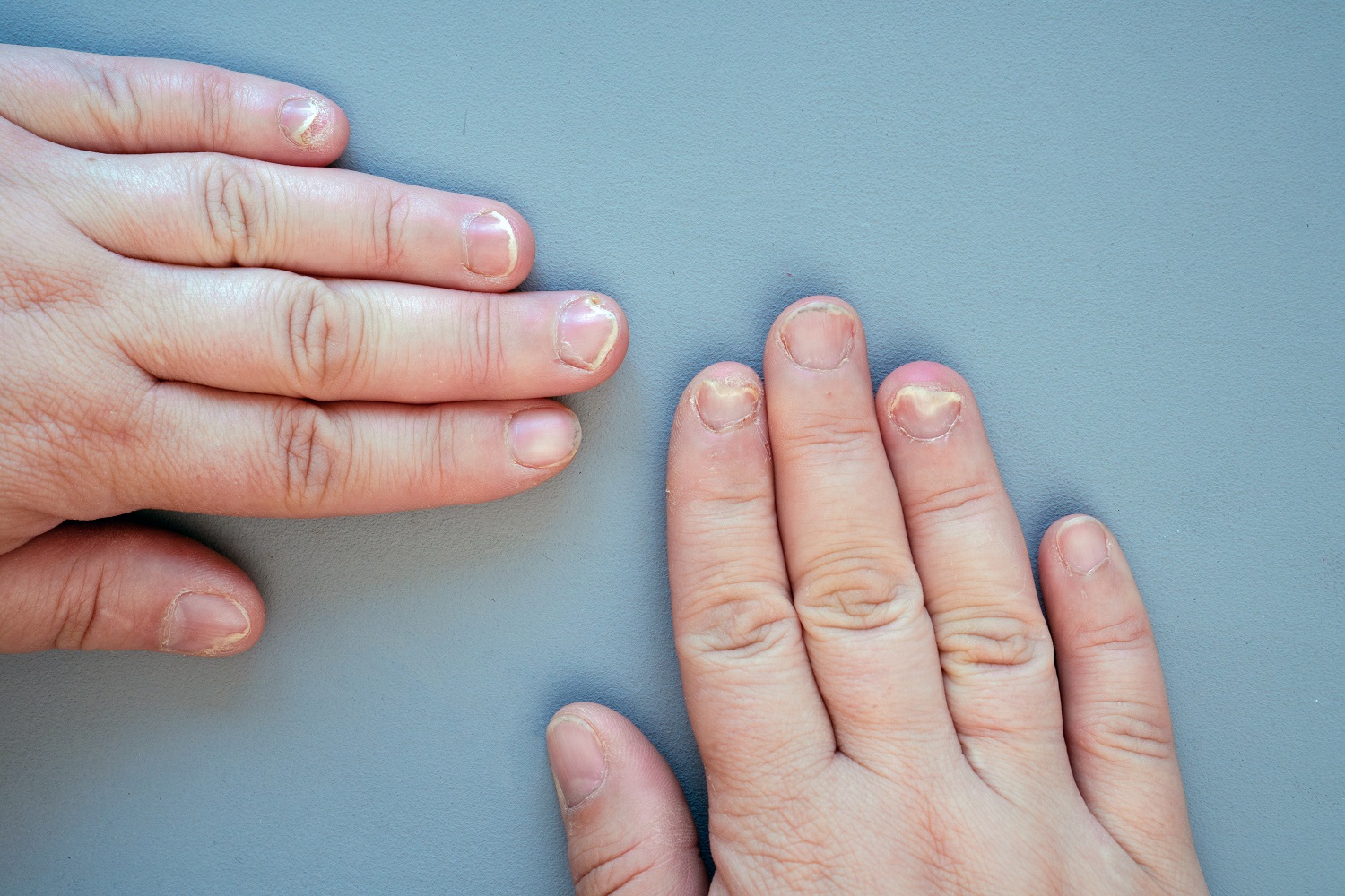 Nail Disorders – Corrigan Podiatry