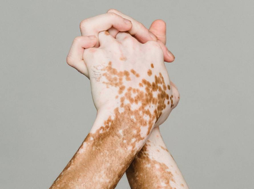 Vitiligo - Symptoms