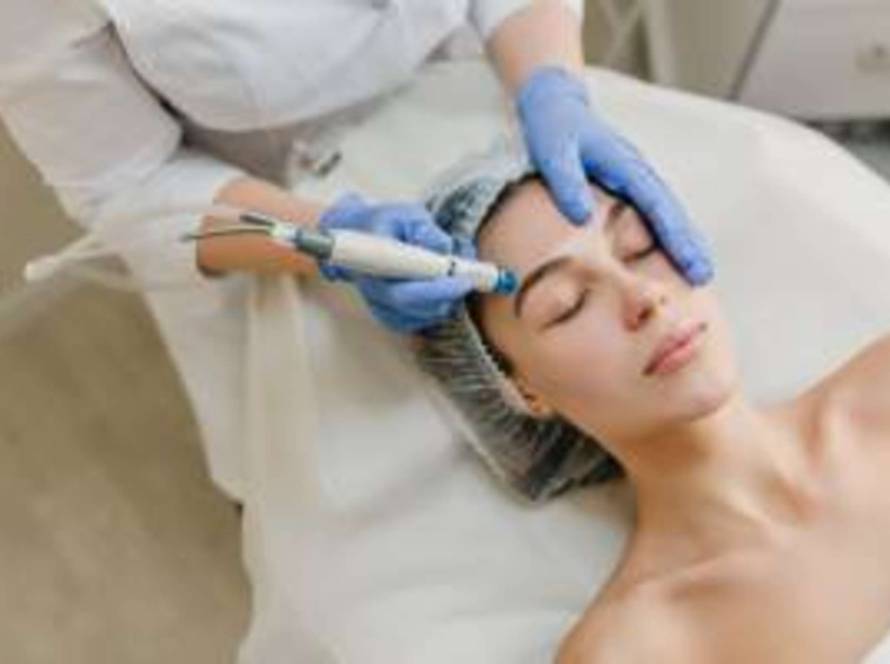 Microneedling Radiofrequency for Erasing Acne Scars