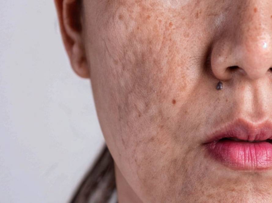 Skin discoloration