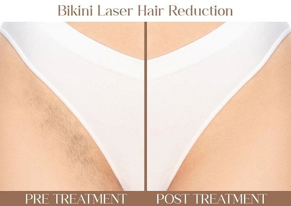 bikini-hair-reduction