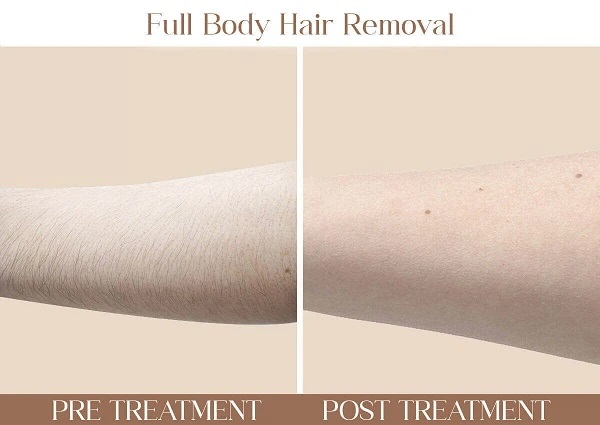 body-hair-reduction (1)