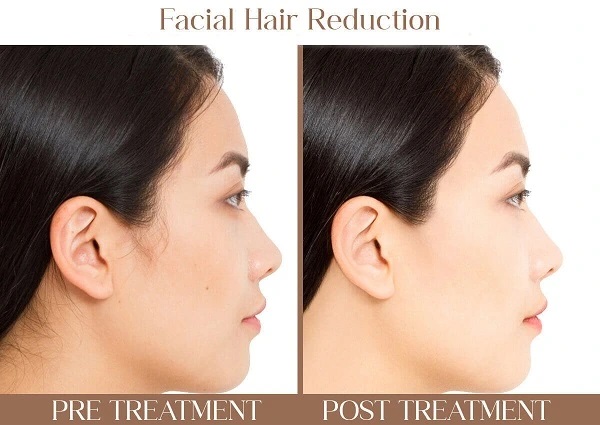 facial-hair-reduction