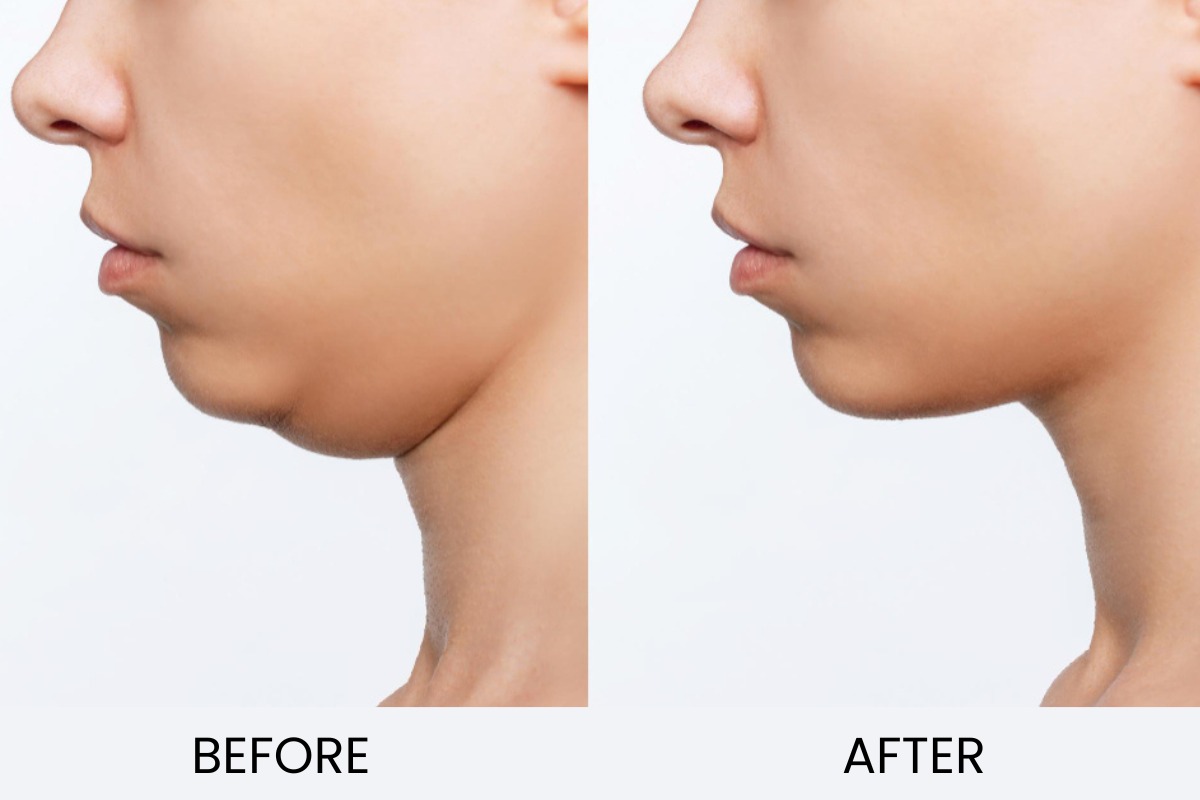 Double Chin Reduction