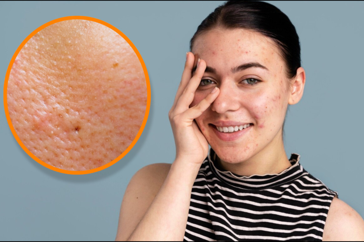 Open Pore Treatment in Delhi
