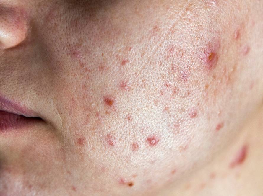 Acne & Pimples Treatment in Delhi