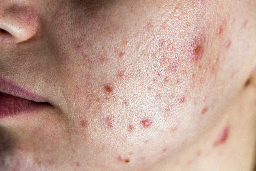 Active Acne & Pimples Treatment in Delhi