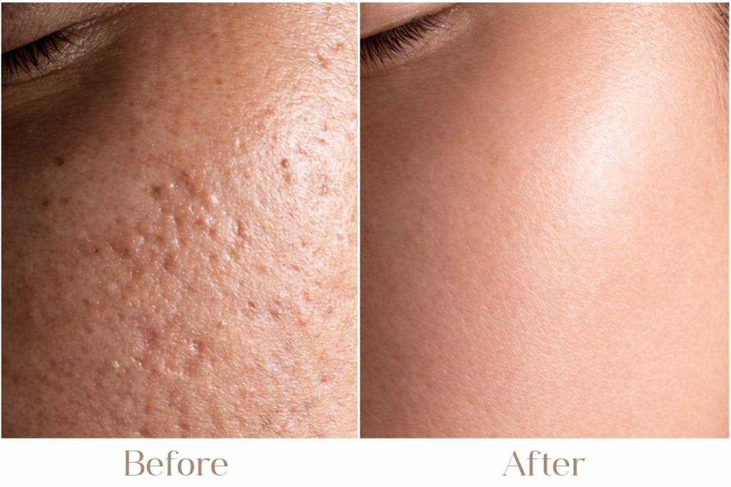 Acne Scars Treatment in Delhi | Iksana Wellness Clinic