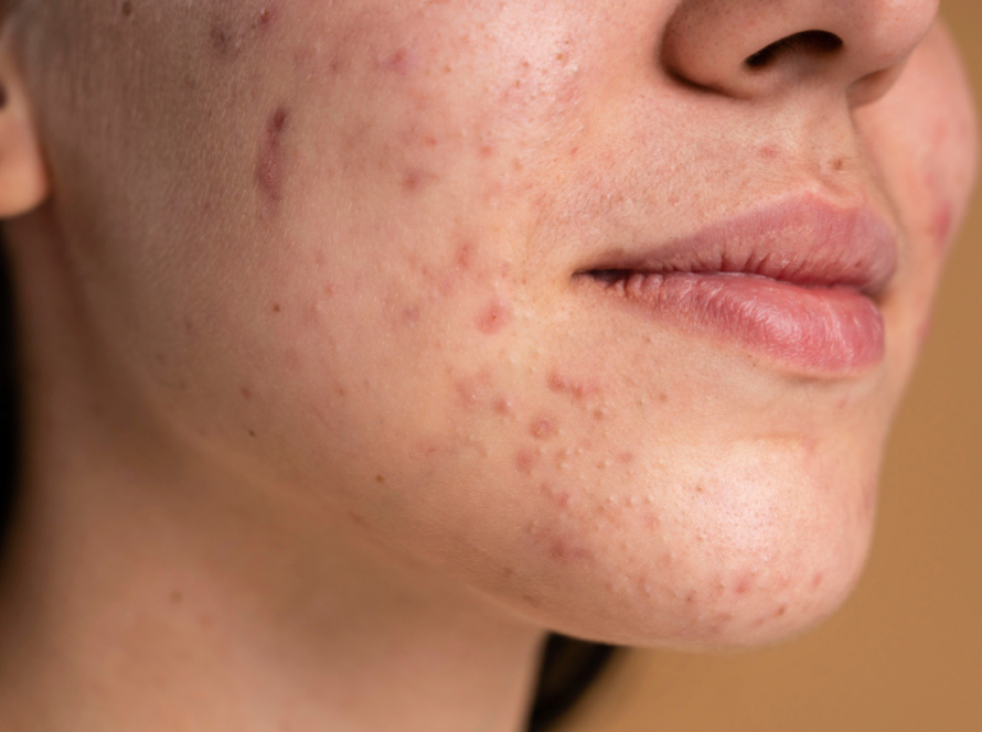 Acne Scars Treatment in Delhi