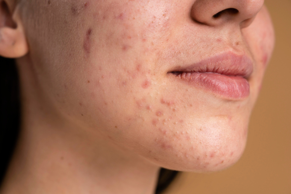 Acne Scars Treatment in Delhi