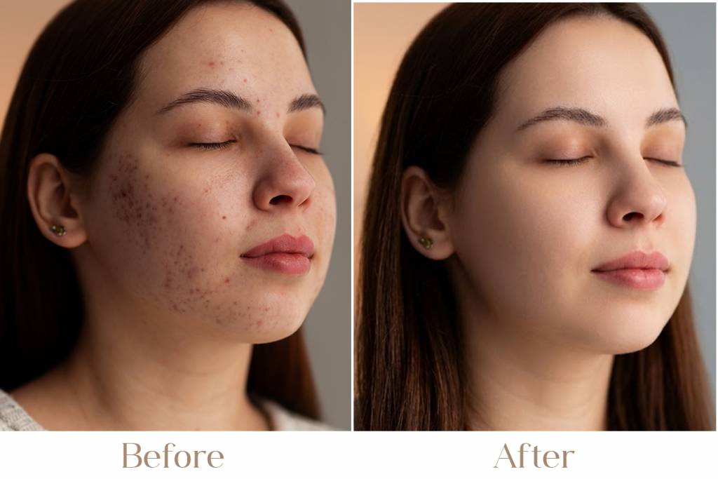 Body Acne Treatment in Delhi