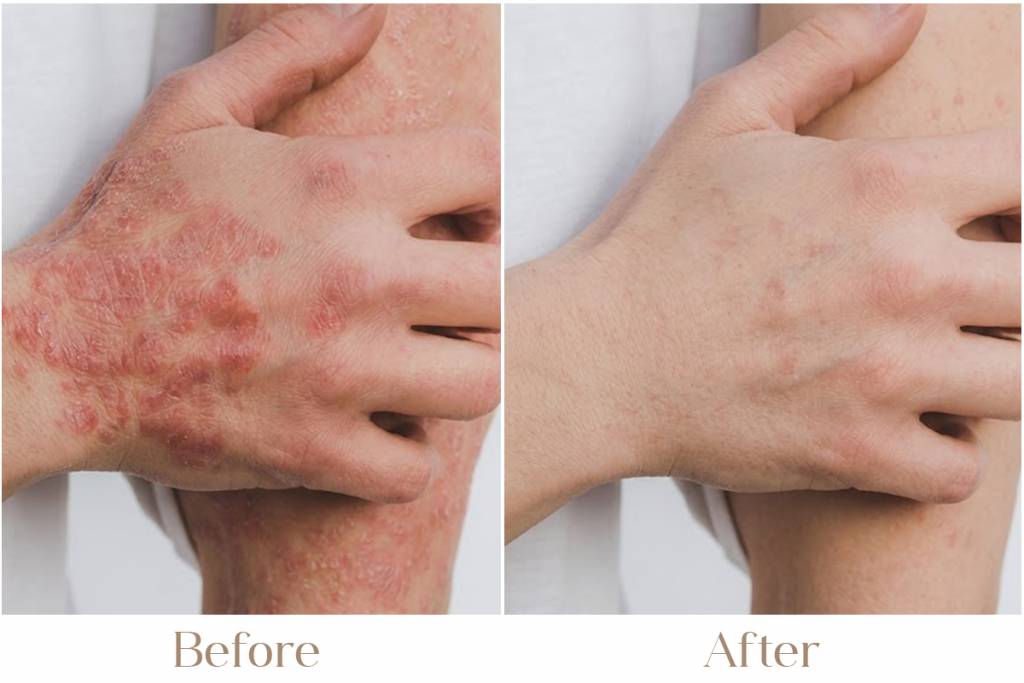 Eczema Treatment in Delhi