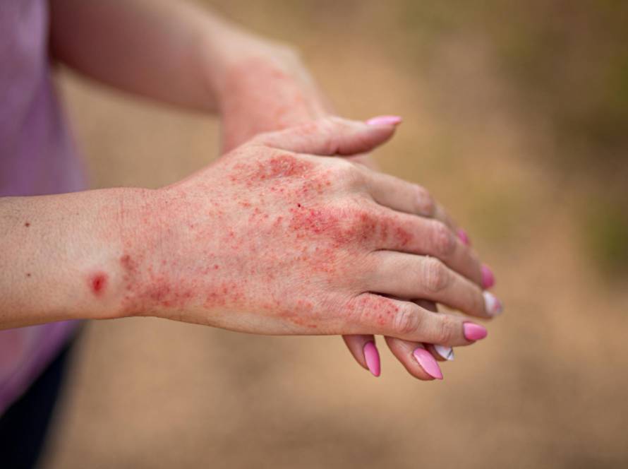 Atopic Dermatitis Treatment in Delhi