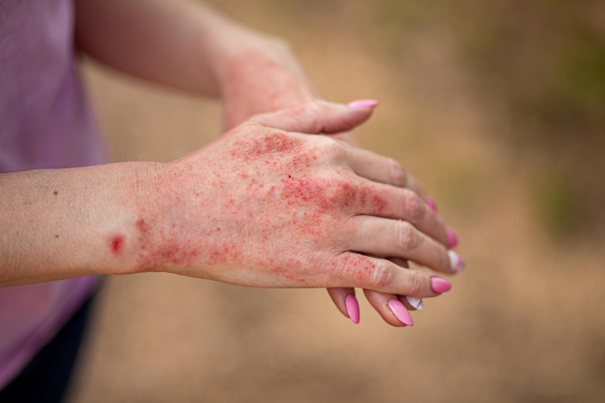 Atopic Dermatitis Treatment in Delhi