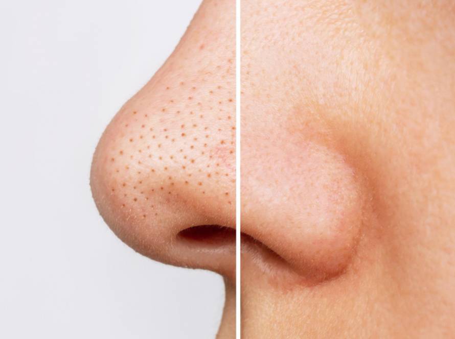Blackheads Removal Treatment in Delhi