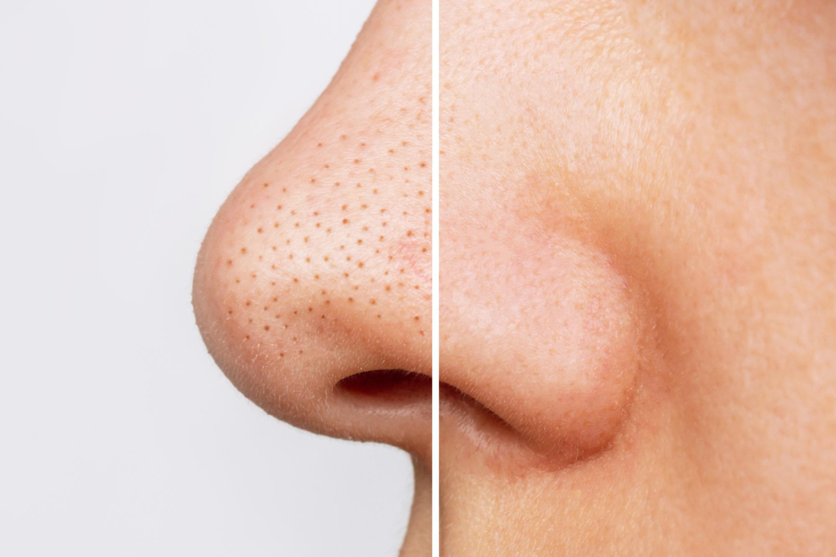 Advanced Blackheads Removal Treatment in Delhi