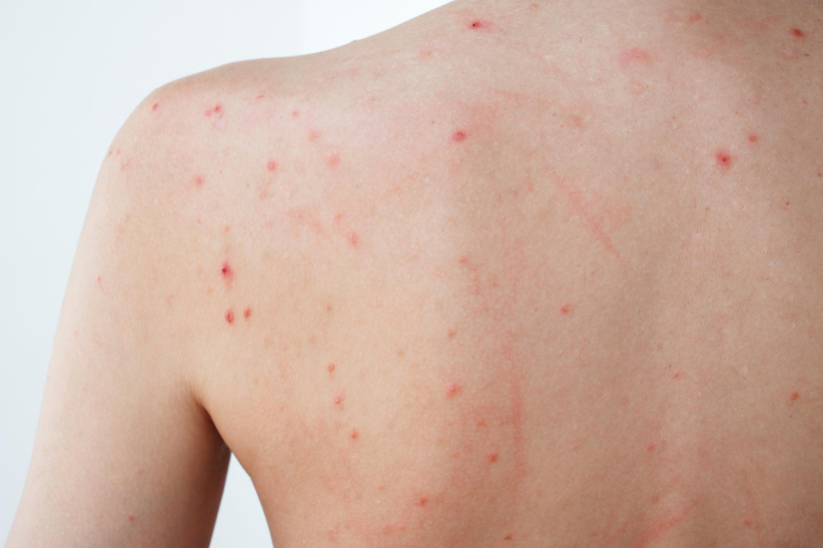 Body Acne Treatment in Delhi