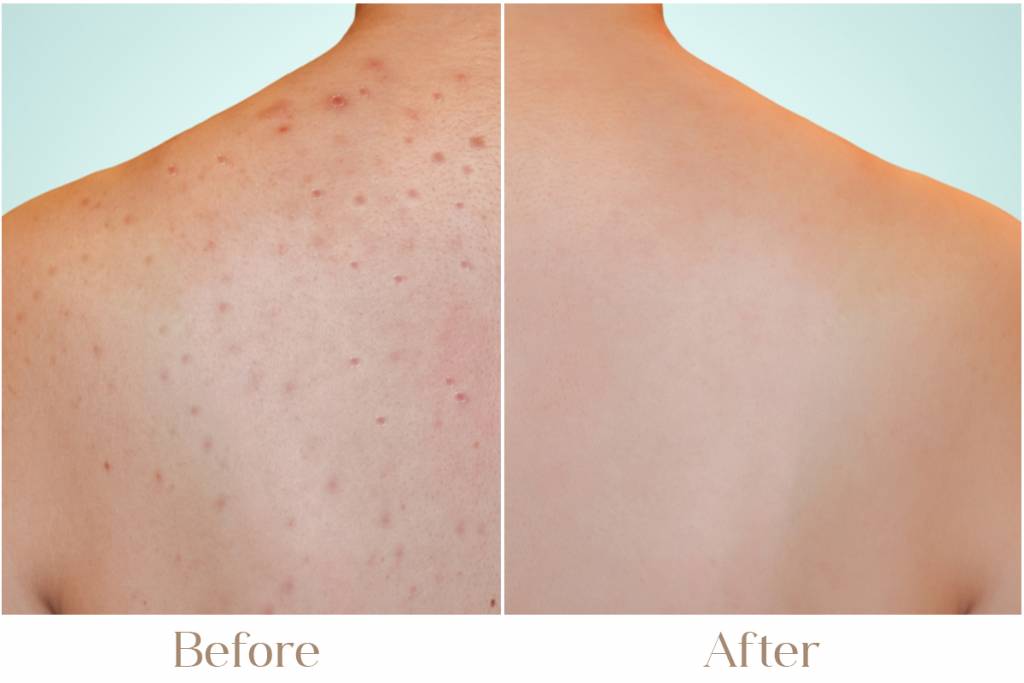 Active Acne & Pimples Treatment in Delhi