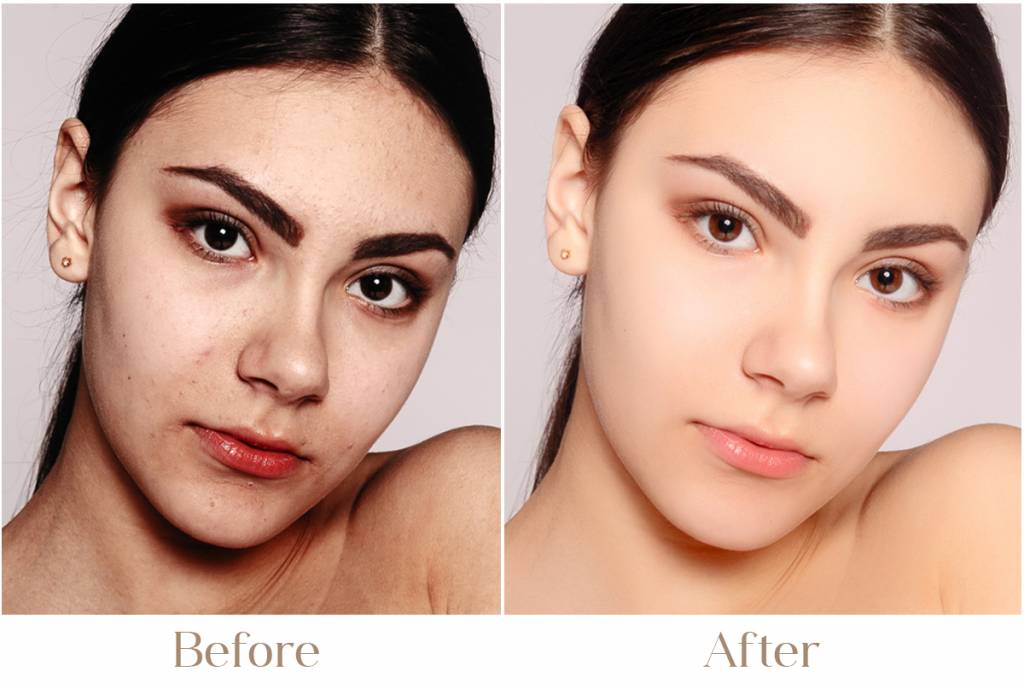 Chemical Peel Treatment in Delhi