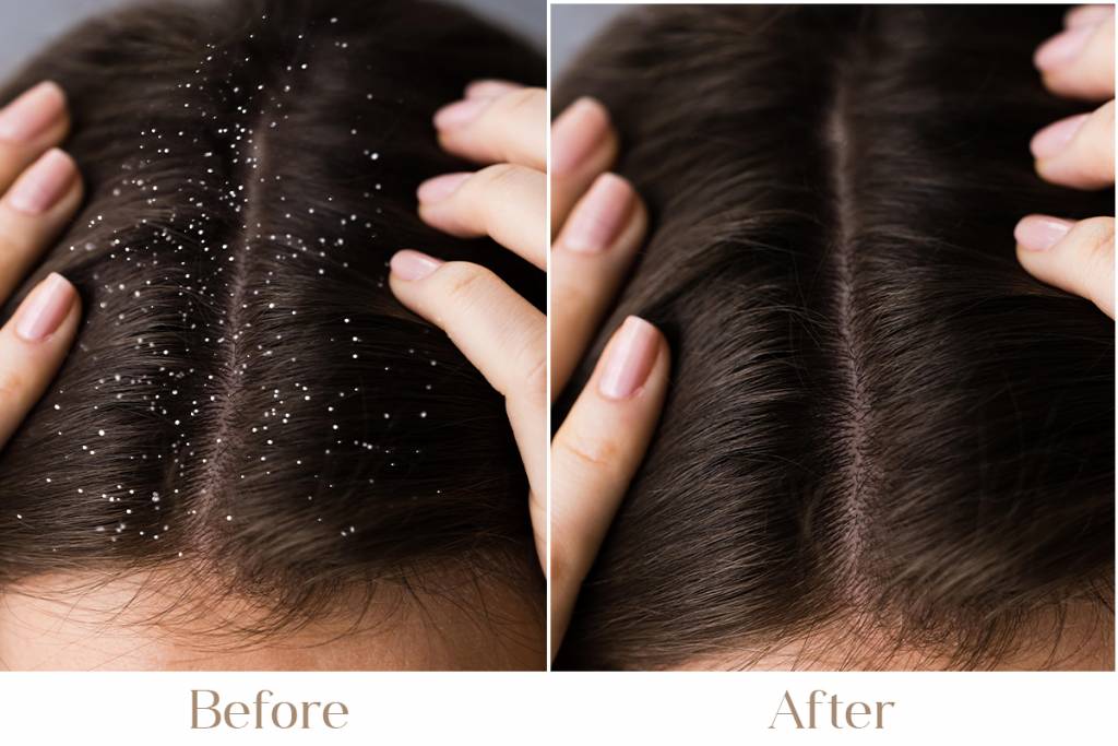 Alopecia Areata Treatment in Delhi