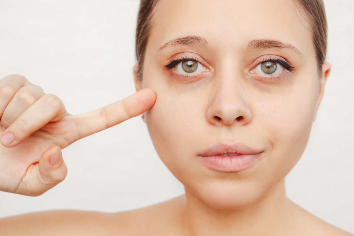 Advanced, Non-Invasive Solutions for Dark Circles & Under-Eye Bags